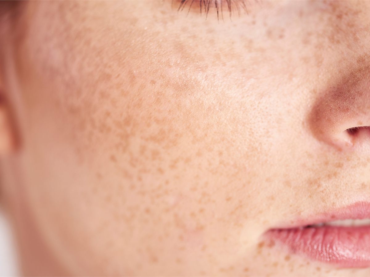 Medical-grade chemical peel at AMAC